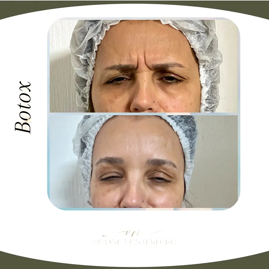 Antes e depois de aplicação de toxina botulínica na testa