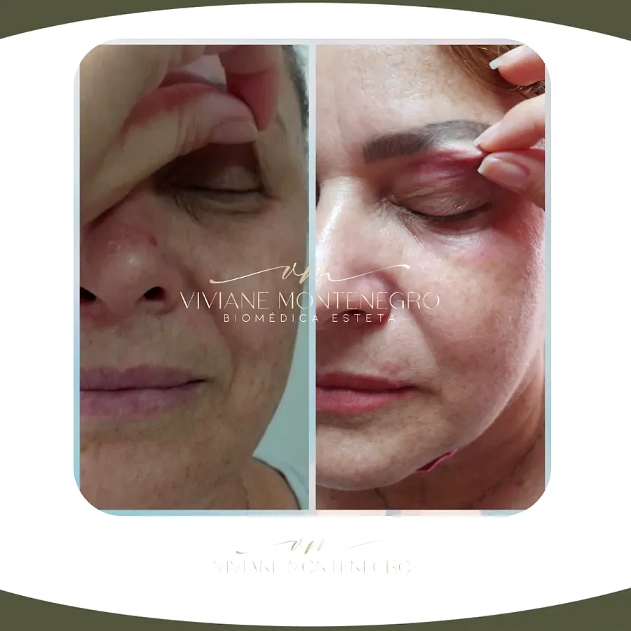 Antes e depois de resultado facial
