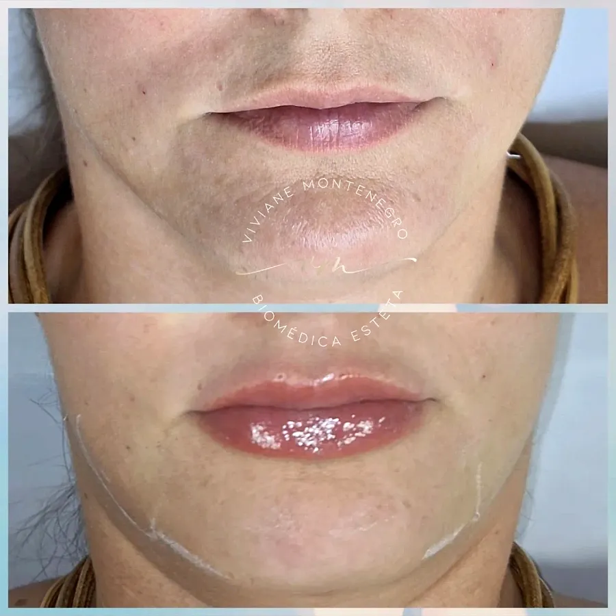 Antes e depois de preenchimento labial