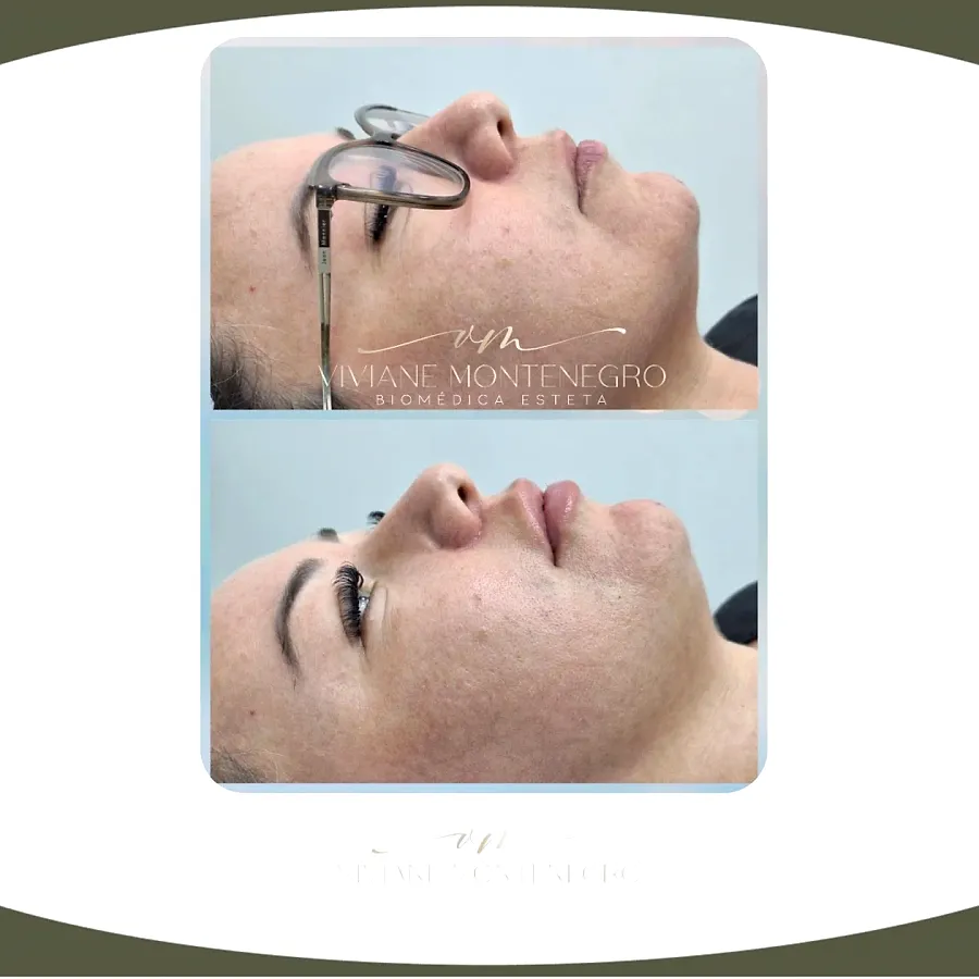 Antes e depois de resultado facial
