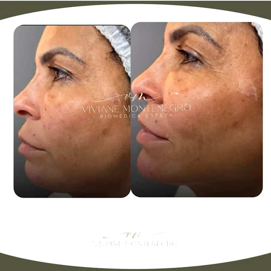 Antes e depois de harmonização facial, vista de perfil