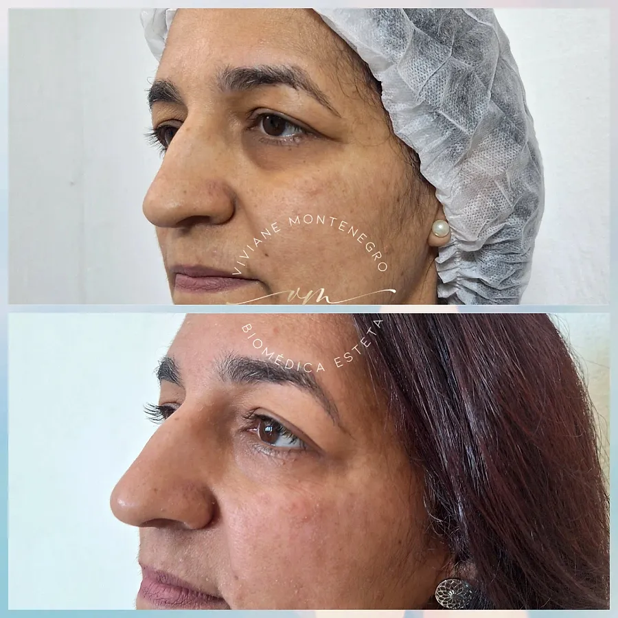 Antes e depois de harmonização facial, vista de perfil