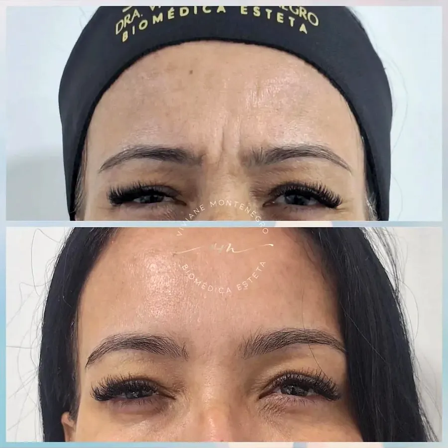 Antes e depois de tratamento das linhas de expressão