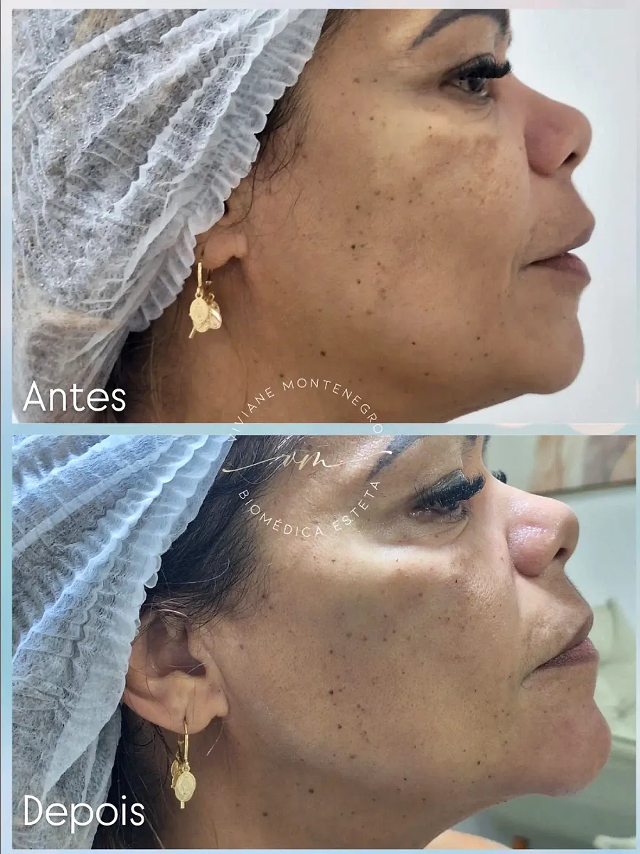 Antes e depois de Full Face