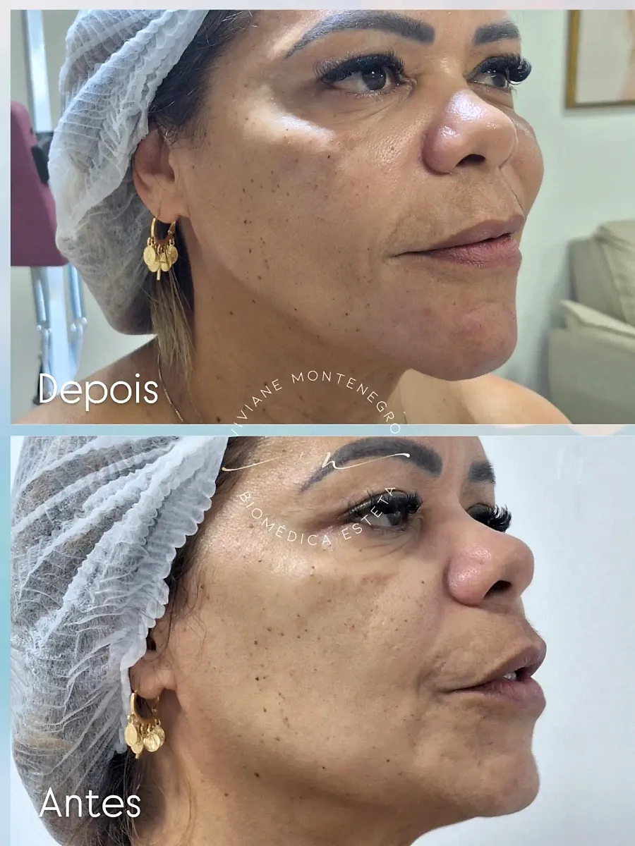 Antes e depois de preenchimento facial