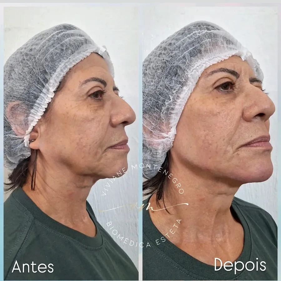 Antes e depois de Full Face, vista de perfil