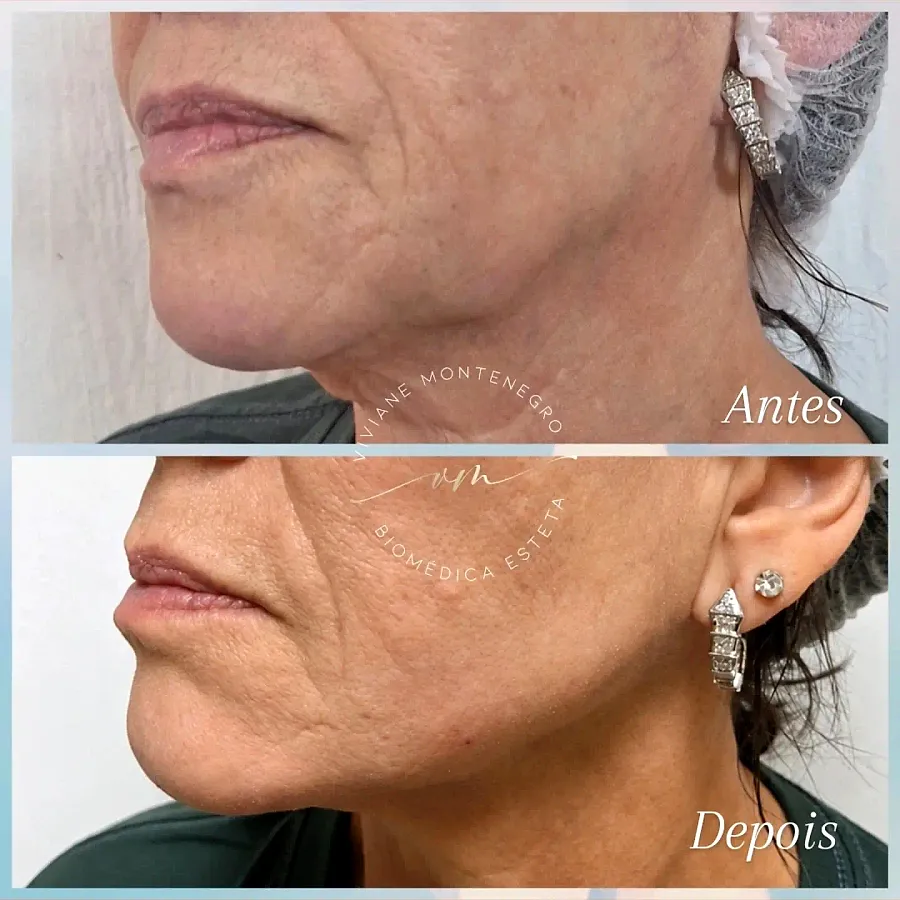 Antes e depois do contorno mandibular