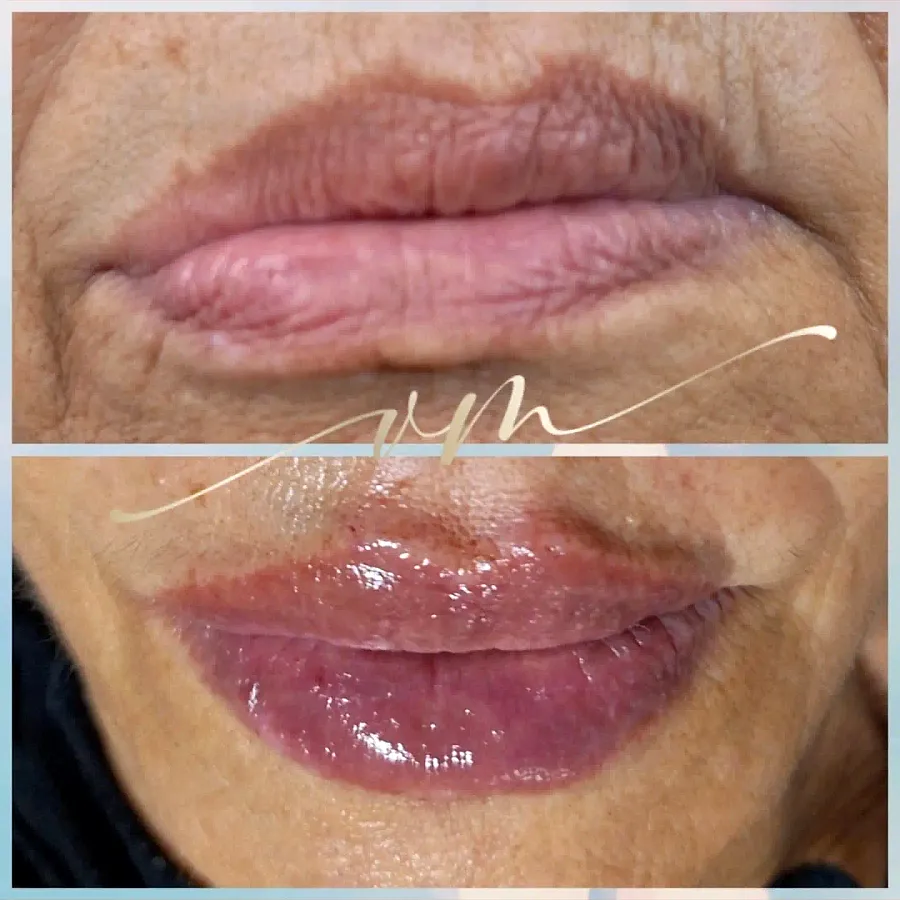 Antes e depois de preenchimento labial com correção de assimetria
