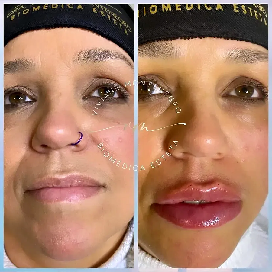 Antes e depois de preenchimento labial, vista frontal