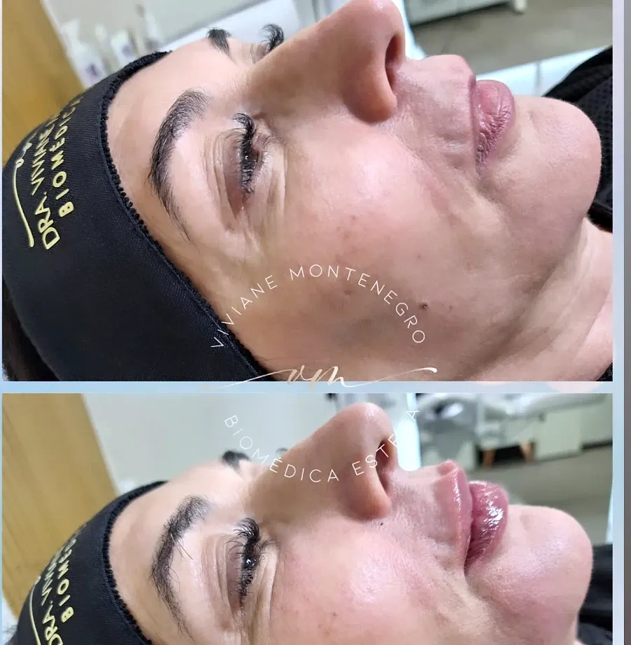 Antes e depois de preenchimento labial
