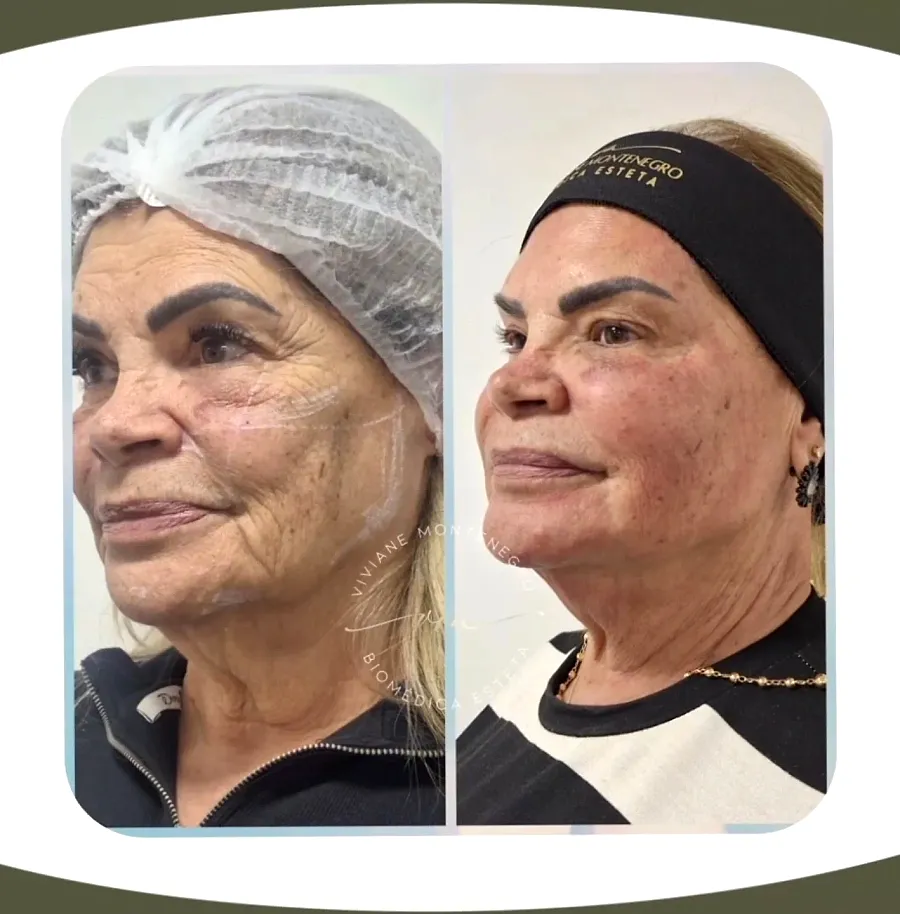 Antes e depois de harmonização facial